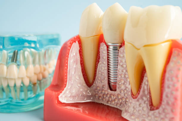 Dental Inlays and Onlays in Lansing, IL